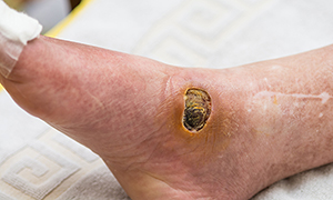 Chronic wounds