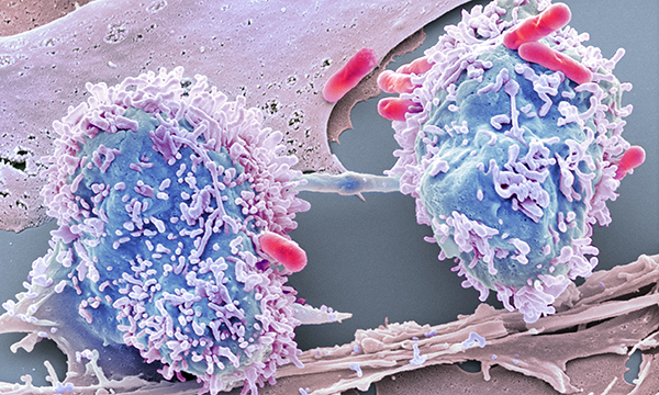 bowel cancer