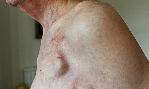 Implantable cardioverter defibrillators
