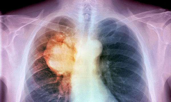 Lung cancer