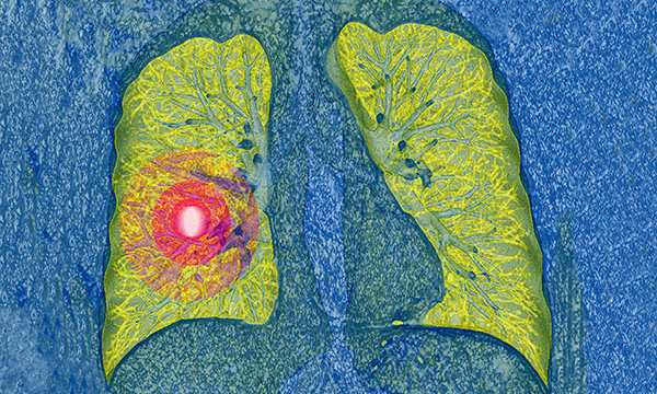 Lung cancer