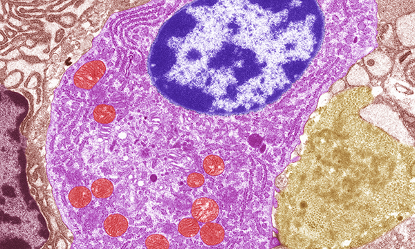 Thyroid cancer