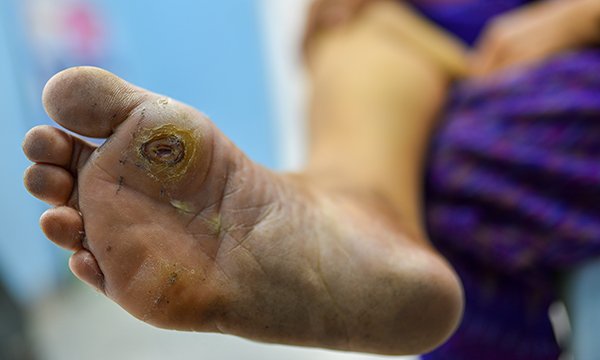 Best practice in the management of diabetic foot ulcers and pressure ulcers on the foot