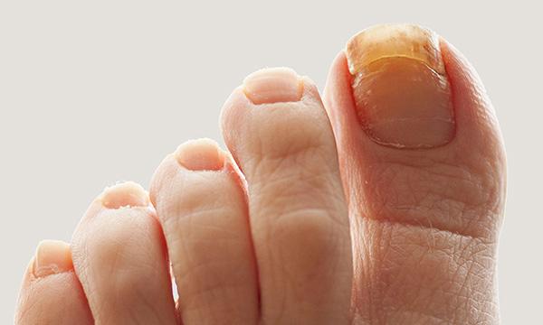 Nail toxicities associated with systemic anticancer therapy