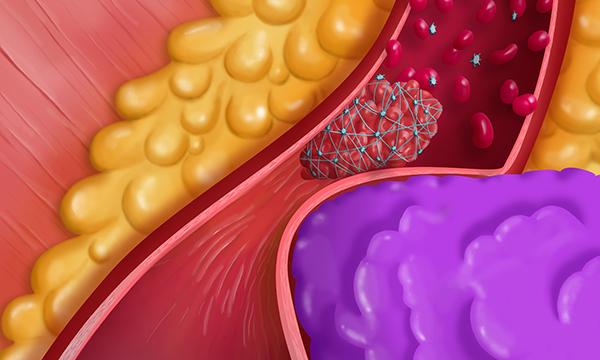 Cancer_arterial_thrombosis,_drawing_-SPL.jpg