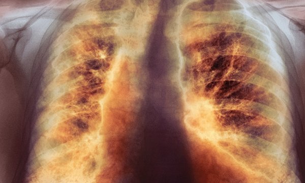 lung scarring
