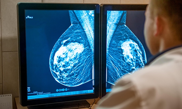Mammogram