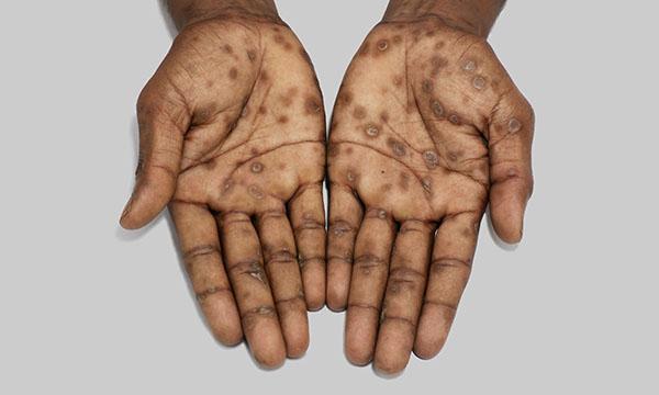 Assessment, diagnosis and management of syphilis: considerations for nurses