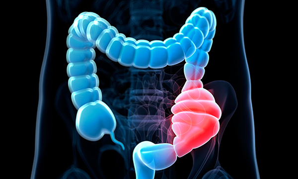 Illustration depicting a constipated colon