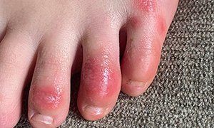 Picture of a condition called 'COVID toe'