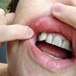 A close-up of someone holding up their top lip to show they have a mouth ulcer, which is a common symptom of Behçet’s syndrome