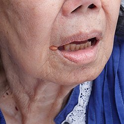 A woman with cheilitis Picture: iStock