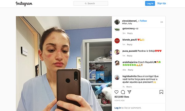 Nurse Alessia Bonari posted a picture of her bruises after wearing a protective mask for extended periods during Italy's COVID-19 epidemic