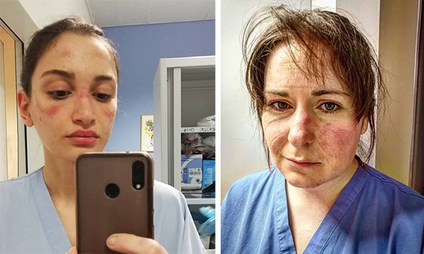Nurses Alessia Bonari, left, and Aimee Goold posted photos on social media that show the impact of wearing PPE for extended periods
