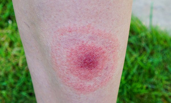 Picture of leg with erythema migrans rash