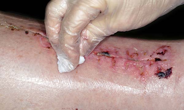 NICE guidance addresses wound cleaning