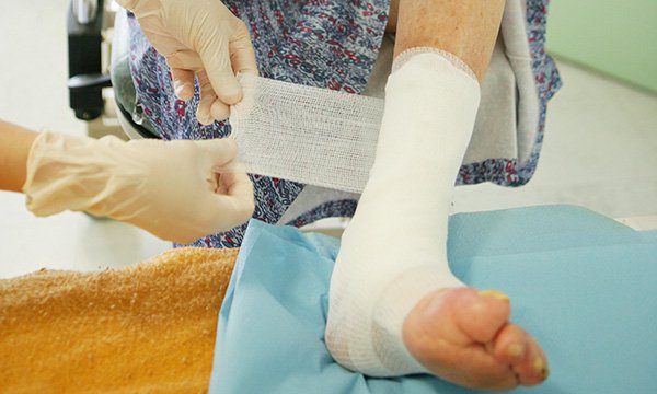 Bandaging as part of wound care for a leg ulcer