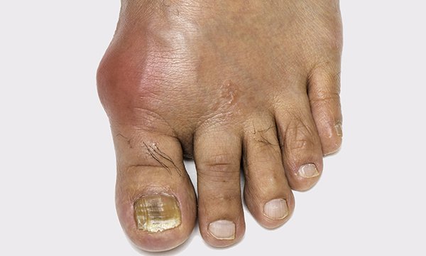 Picture shows a foot affected by gout. Most patients treated by nurses for gout were more satisfied, had greater knowledge, stuck to their medication and had fewer flares than those treated by a GP. 