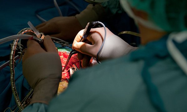 Picture shows a surgeon operating on a patient. A chemical that assists brain cancer surgery by making tumour cells fluorescent could also help to safely diagnose the disease and monitor its response to treatment, a study suggests.