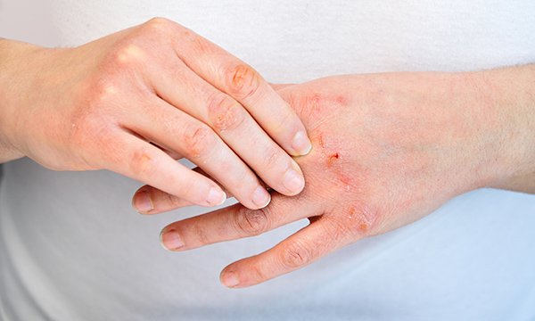 pair of hands with signs of dermatitis