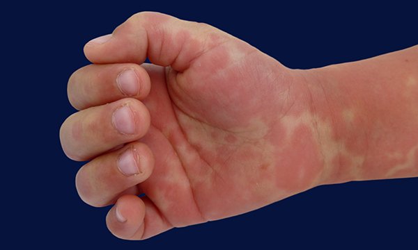 A childs hand covered in red blotches. Symptoms of Kawasaki disease can include red fingers. Picture: Science Photo Library