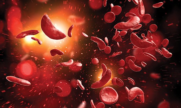 A computerised image illustrating the effects of sickle cell disease