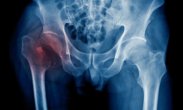 An X-ray showing a hip fracture marked in red