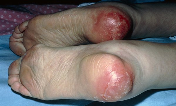 pressure ulcers on the heel