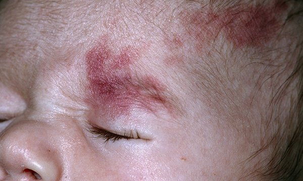 A baby's face with port wine birthmarks on it.