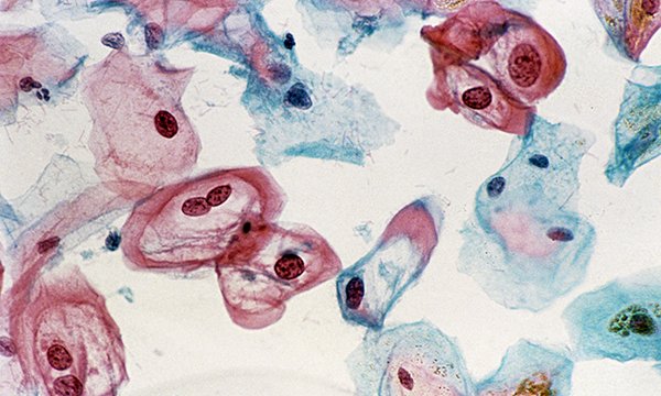 Picture shows a light micrograph of a cervical smear revealing epithelial cells infected with HPV. In this patient, the smear would be considered borderline abnormal.