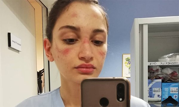 Nurse Alessia Bonari posted a picture of her bruises after wearing a protective mask for extended periods during Italy's COVID-19 epidemic