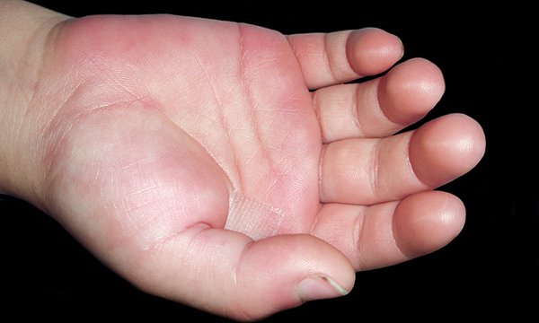 A child's hand displaying signs of kawasaki disease
