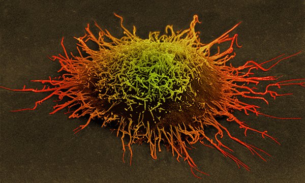 Cervical_cancer_cell-SPL.jpg