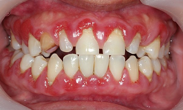 Gum_Disease-iStock.jpg