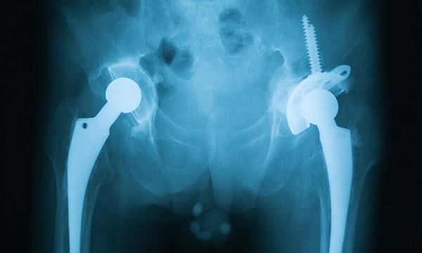 total hip replacement 