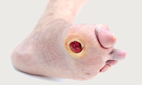 Foot ulcers in older people with diabetes mellitus: prevention and management