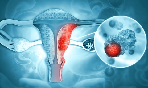 Awareness and understanding of Lynch syndrome among patients with endometrial cancer