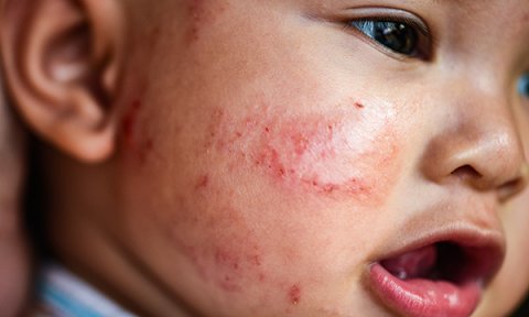 Biological basis of child health 13: structure and functions of the skin, and common children’s skin conditions