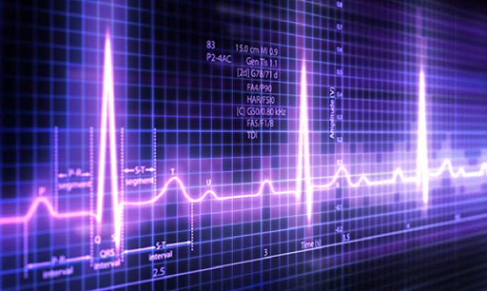 Electrocardiograms: a guide to rhythm recognition for emergency nurses 
