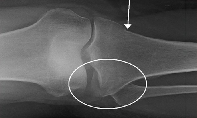 Assessment and management of patients with tibial plateau fractures in emergency departments