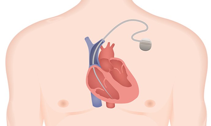 Implantable cardioverter defibrillators