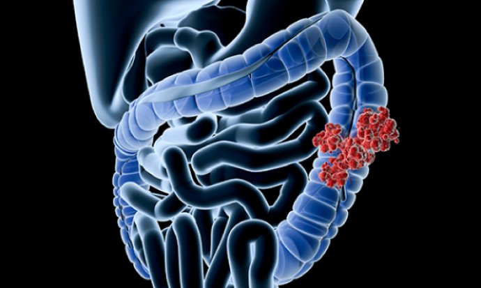 Presentation, diagnosis and treatment of colorectal cancer