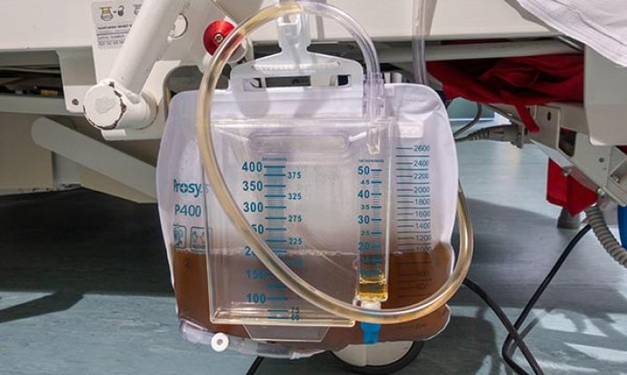 Care of patients undergoing the removal of an indwelling urinary catheter
