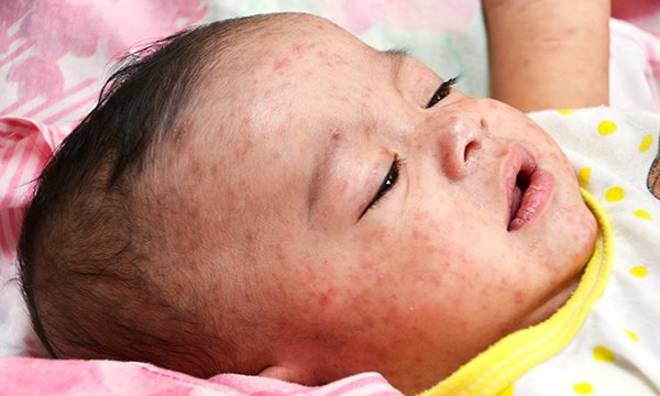Measles is a potentially life-threatening condition Picture: Science Photo Library