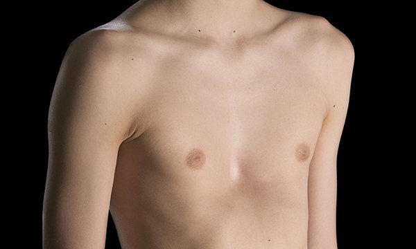 Picture shows a young male with pectus excavatum, in which the chest sinks inwards. Specialist nurse Cheryl Honeyman says the end of funding for surgery on chest deformities in young people is wrong and calls for more research