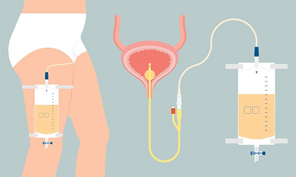 urinary catheters | RCNi