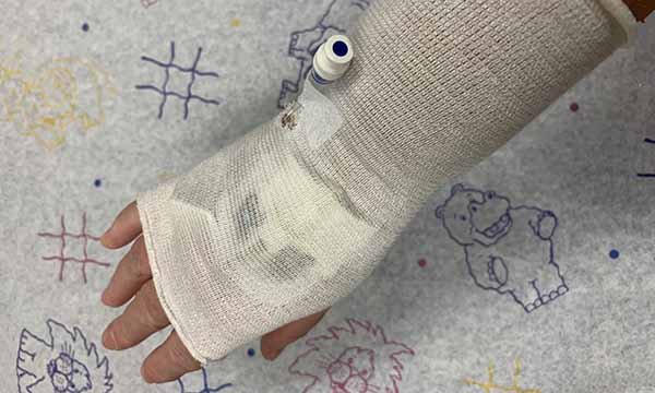 Reducing pressure injuries in children caused by peripheral intravenous cannulae