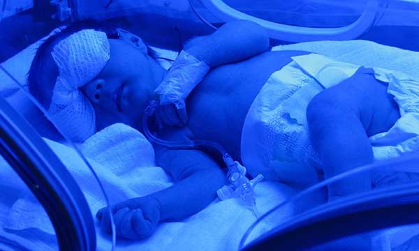 A baby receiving phototherapy: it is now an established treatment for neonatal jaundice