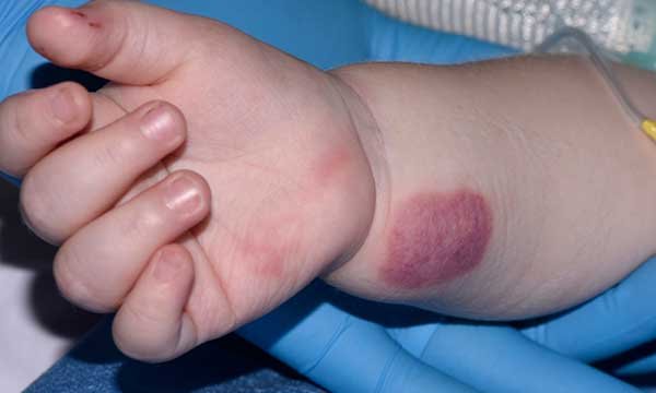 Picture shows burn on the arm due to use of a glove: filling examination gloves with warm water can help widen blood vessels for cannulation, but nurses should be aware of the risks of accidental burns to patients