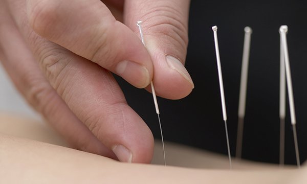 The role of acupuncture as an adjunct pain relief option for people with cancer